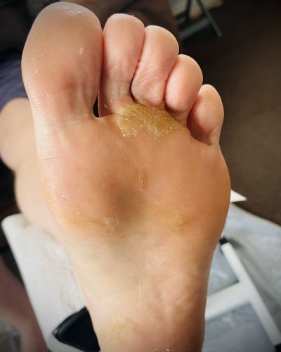 Image showing a bad case of athletes foot
