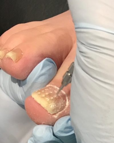 Image showing a customer being treated for fungal nail