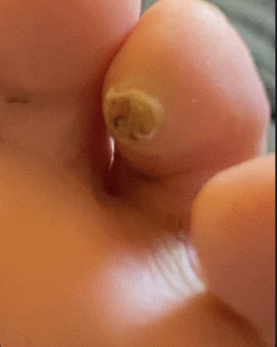 Image showing a corn on one of the smaller toes