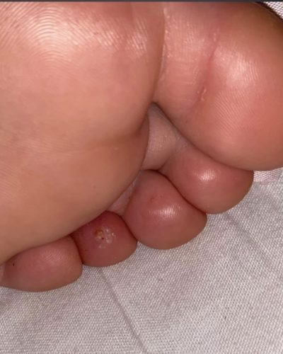 Image of corn on smaller toe from a side angle view