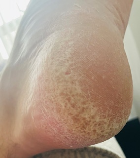 Image showing a client with hard skin on their heel about to be removed